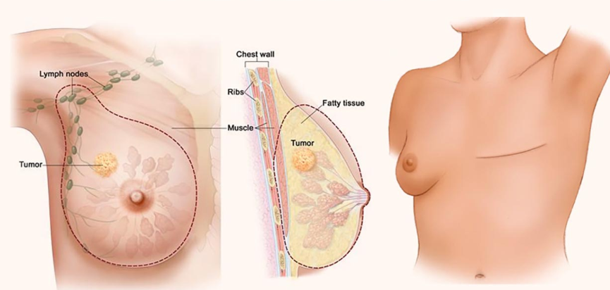 Phẫu thuật cắt ngực là gì?